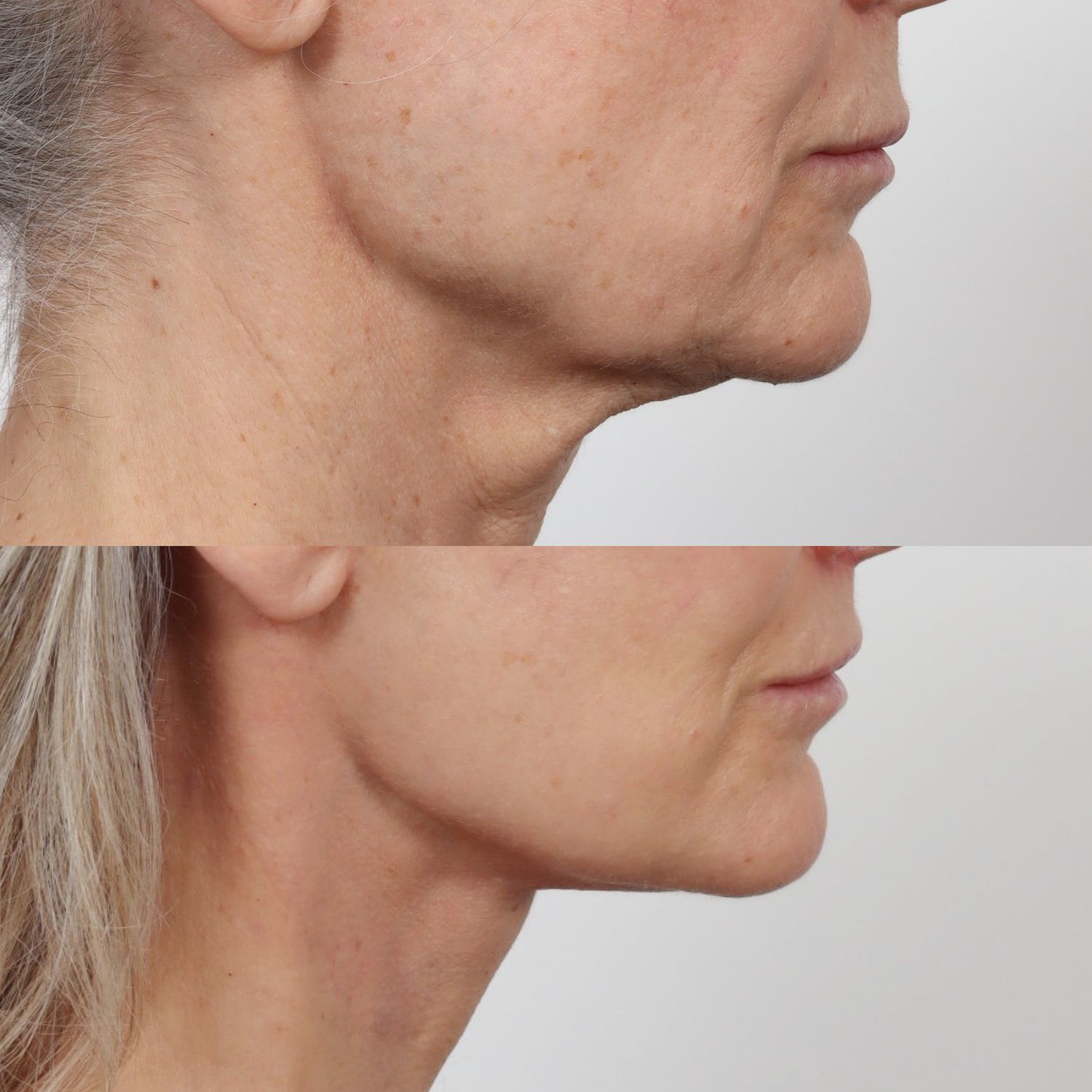 Deep Plane Facelift Before & After