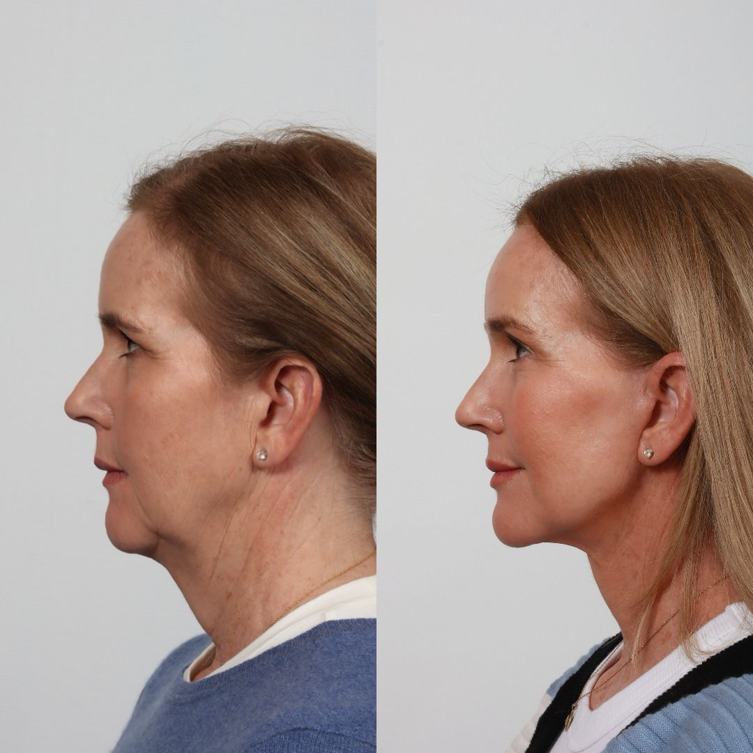 Deep Plane Facelift Before & After