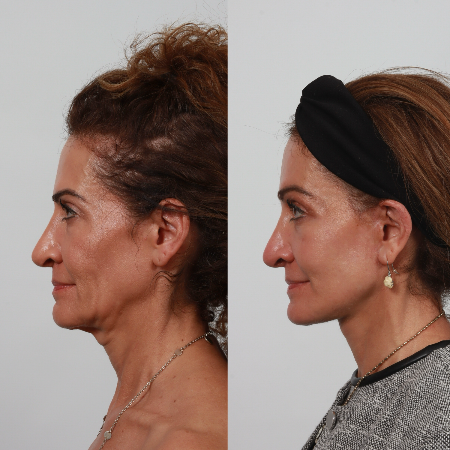 Deep Plane Facelift Before & After