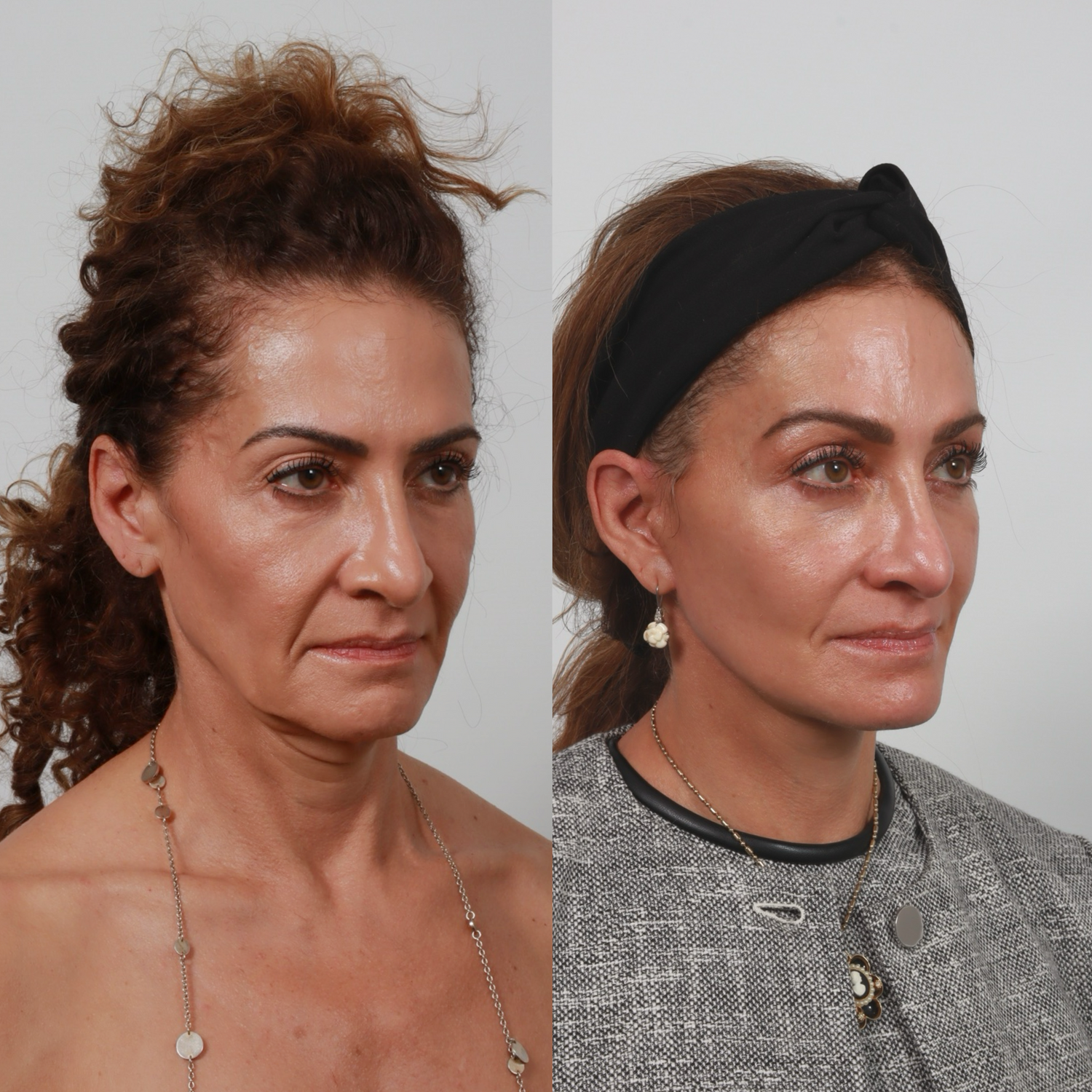 Deep Plane Facelift Before & After