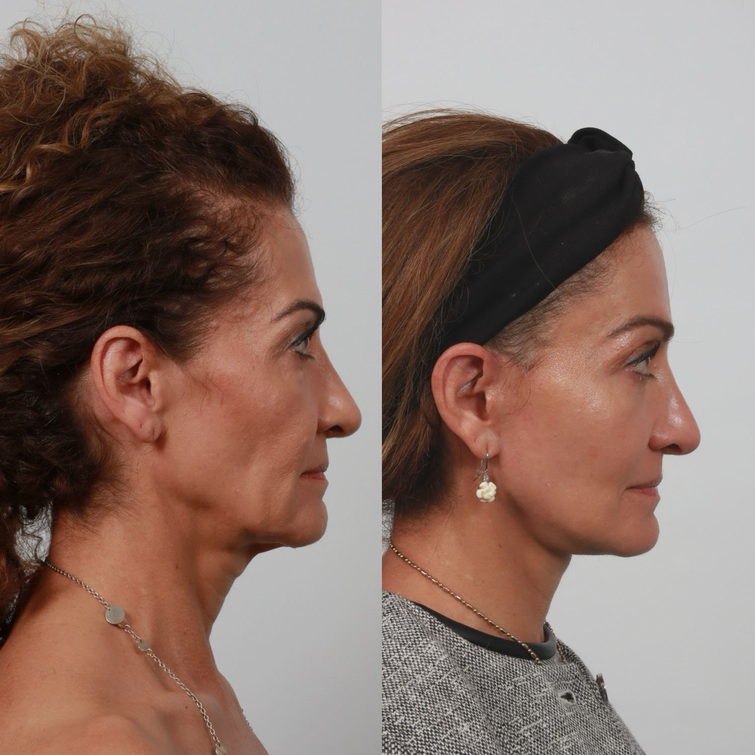 Deep Plane Facelift Before & After