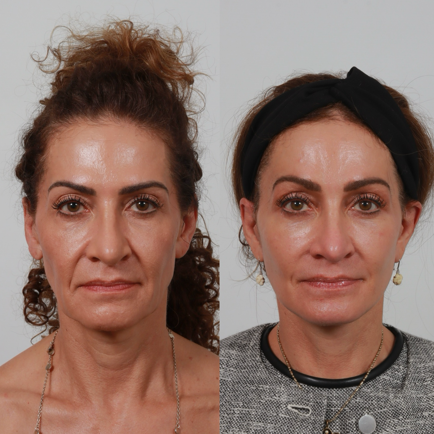 Deep Plane Facelift Before & After