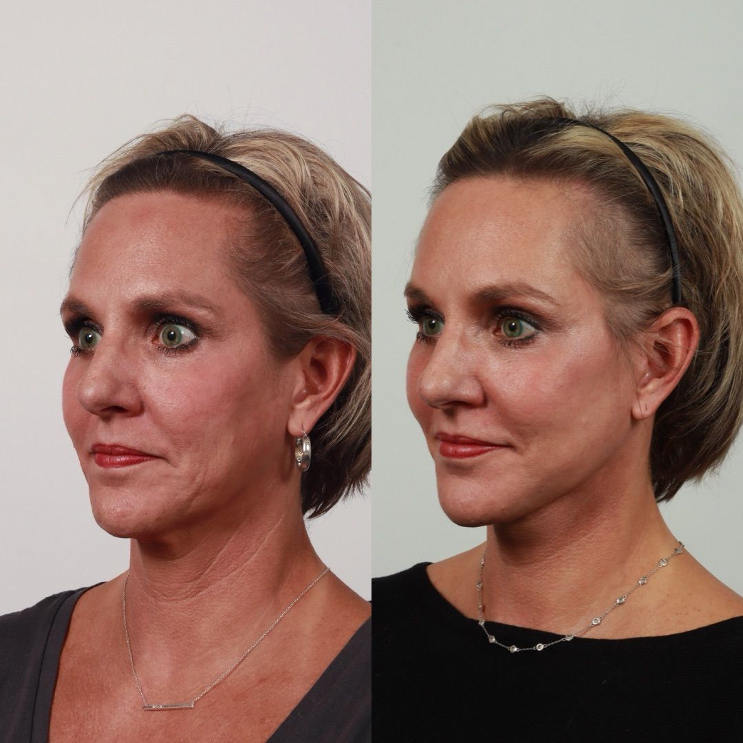 Deep Plane Facelift Before & After