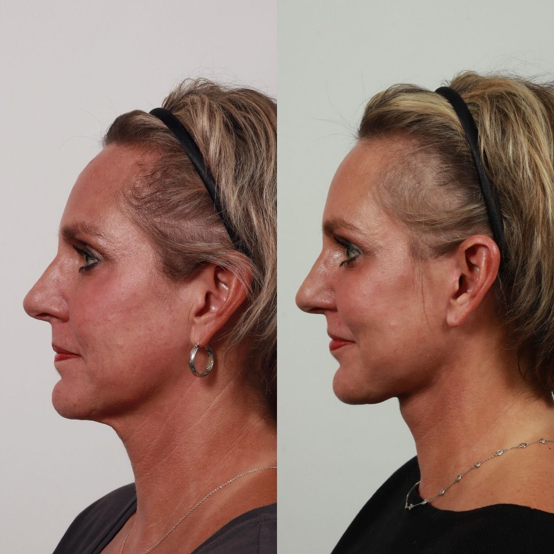 Deep Plane Facelift Before & After