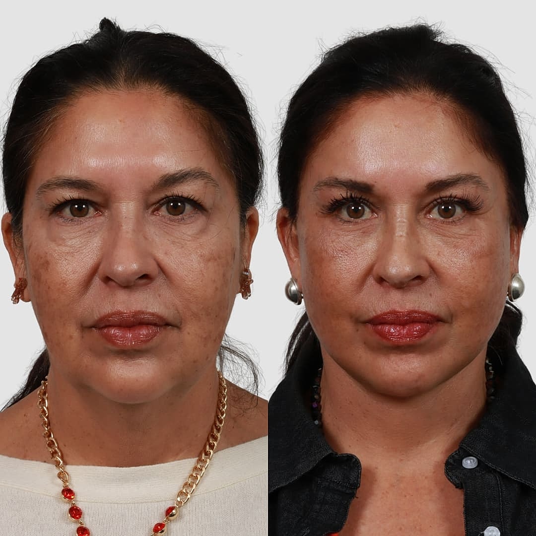 Deep Plane Facelift Before & After