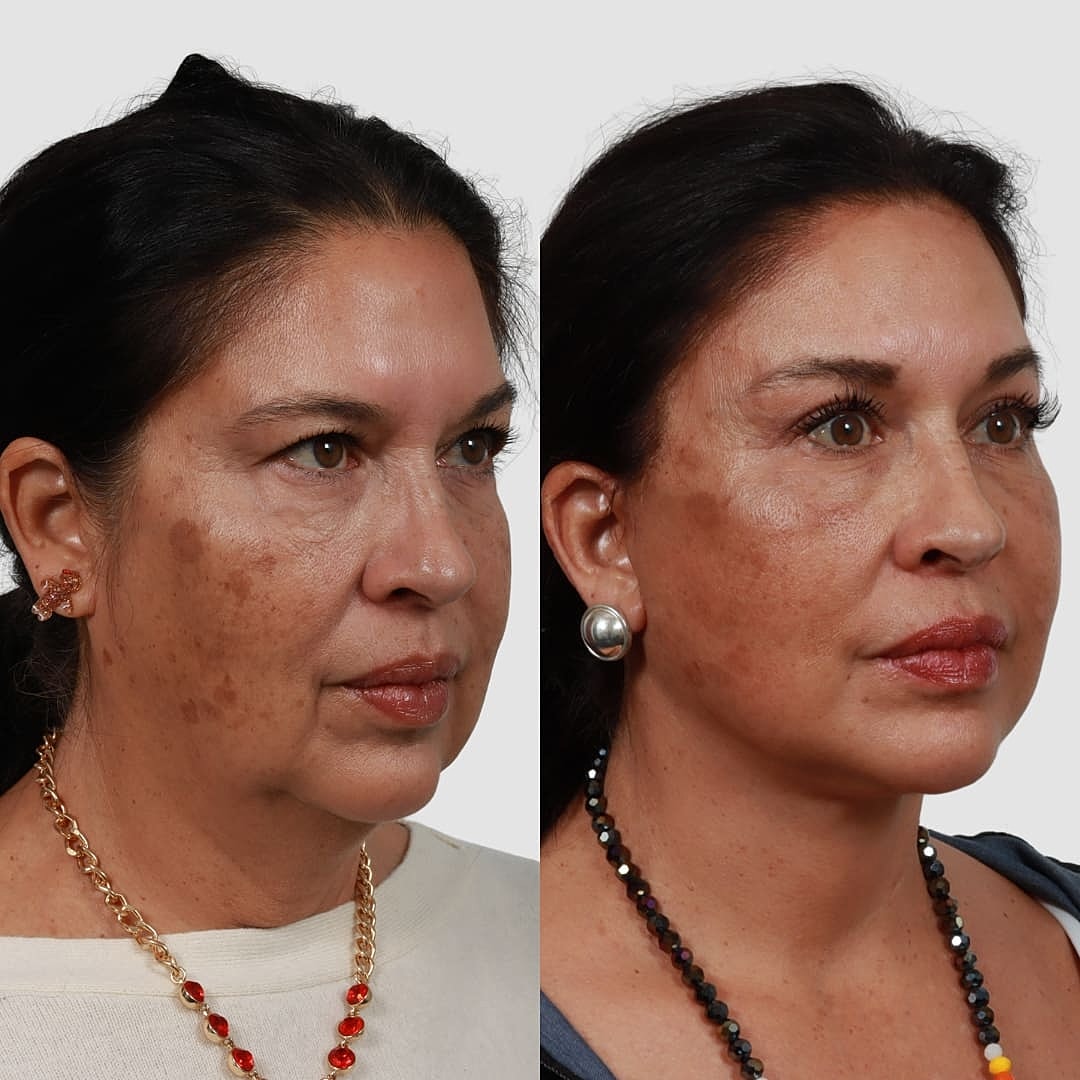 Deep Plane Facelift Before & After