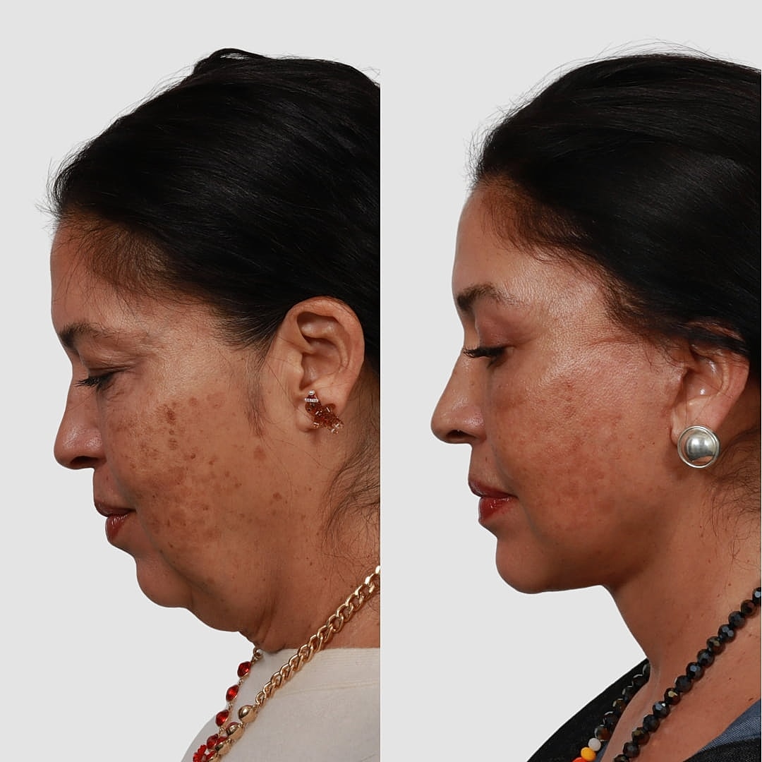 Deep Plane Facelift Before & After