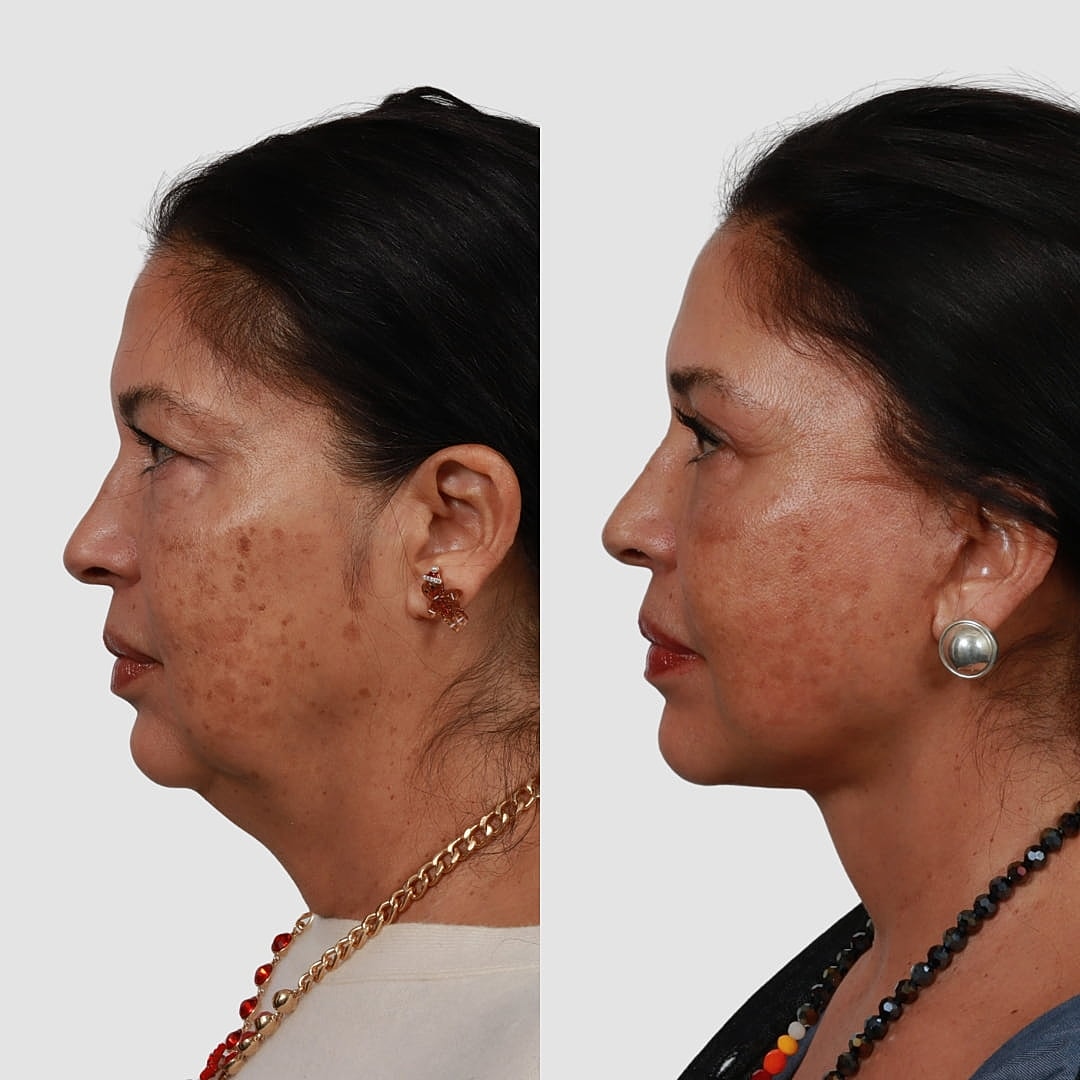 Deep Plane Facelift Before & After
