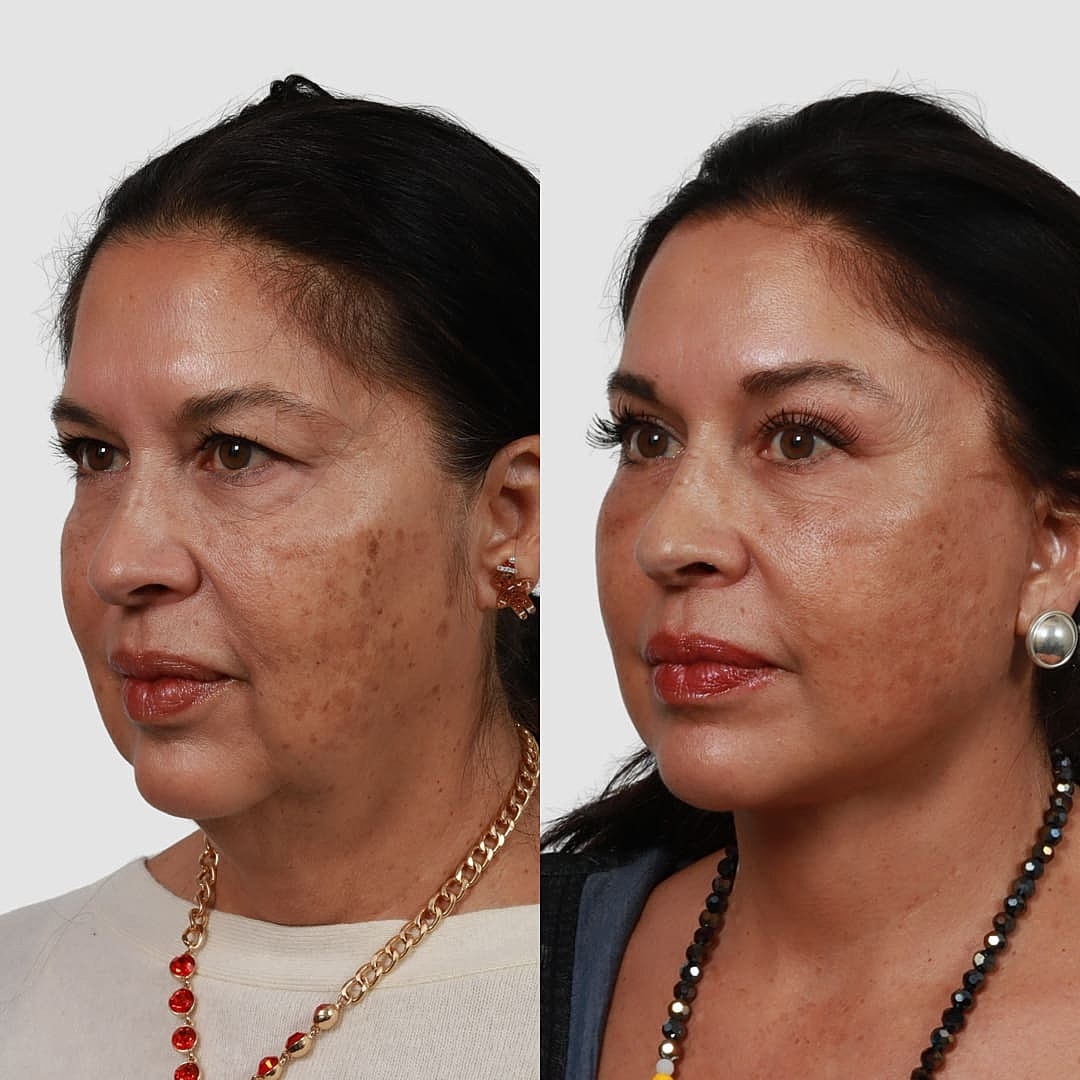Deep Plane Facelift Before & After