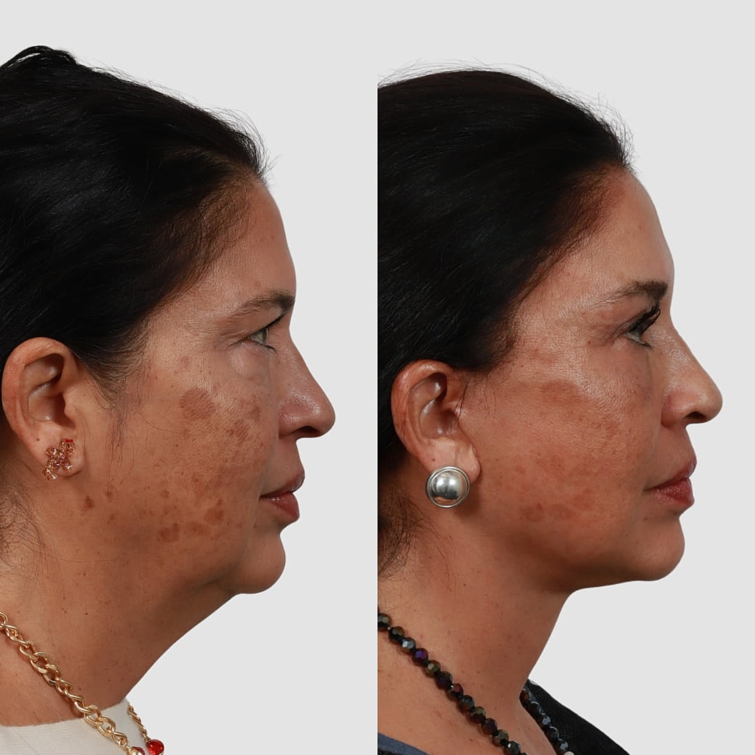 Deep Plane Facelift Before & After