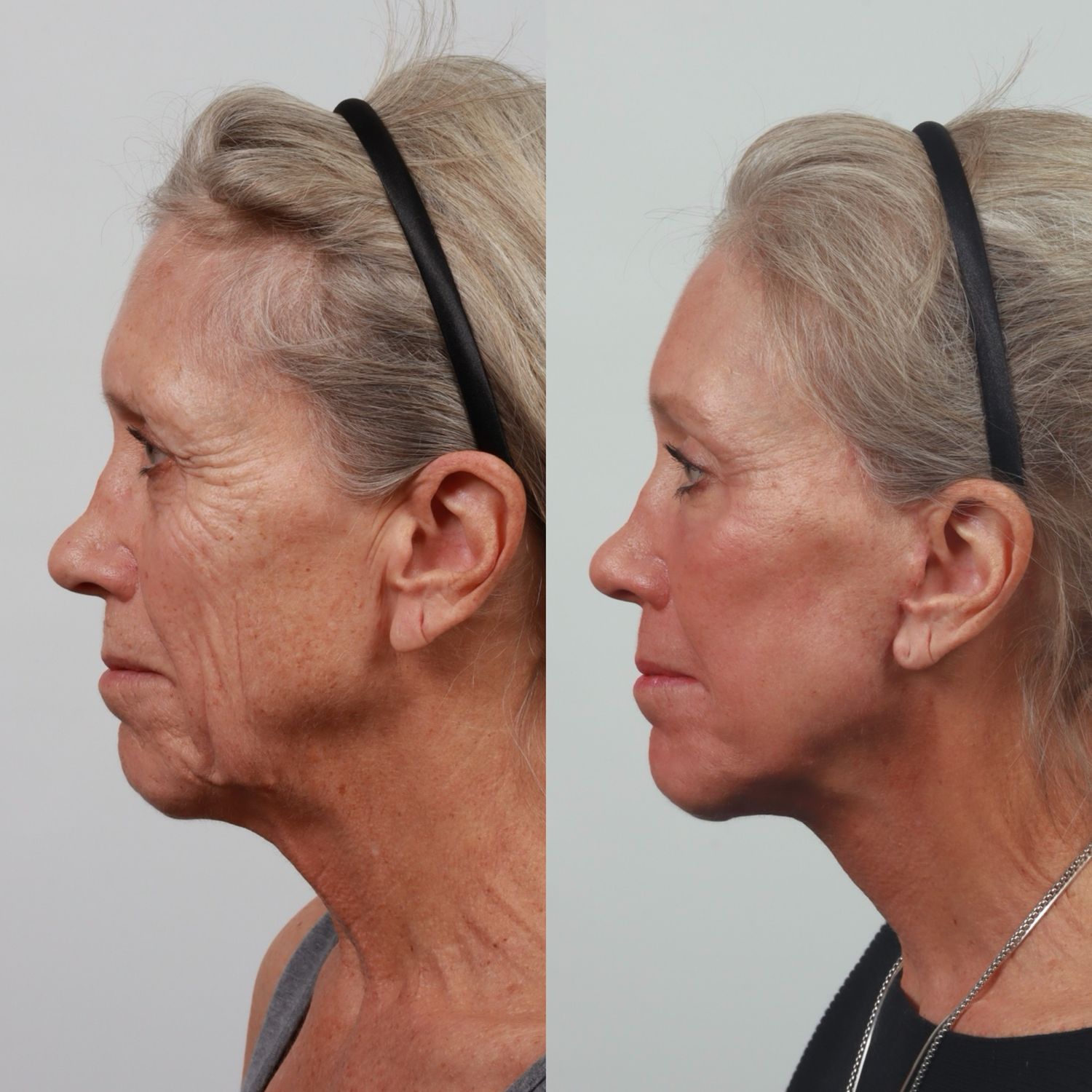 Deep Plane Facelift Before & After