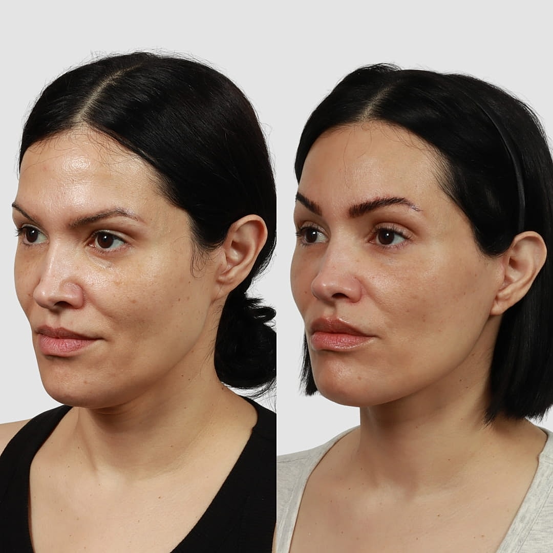 Deep Plane Facelift Before & After