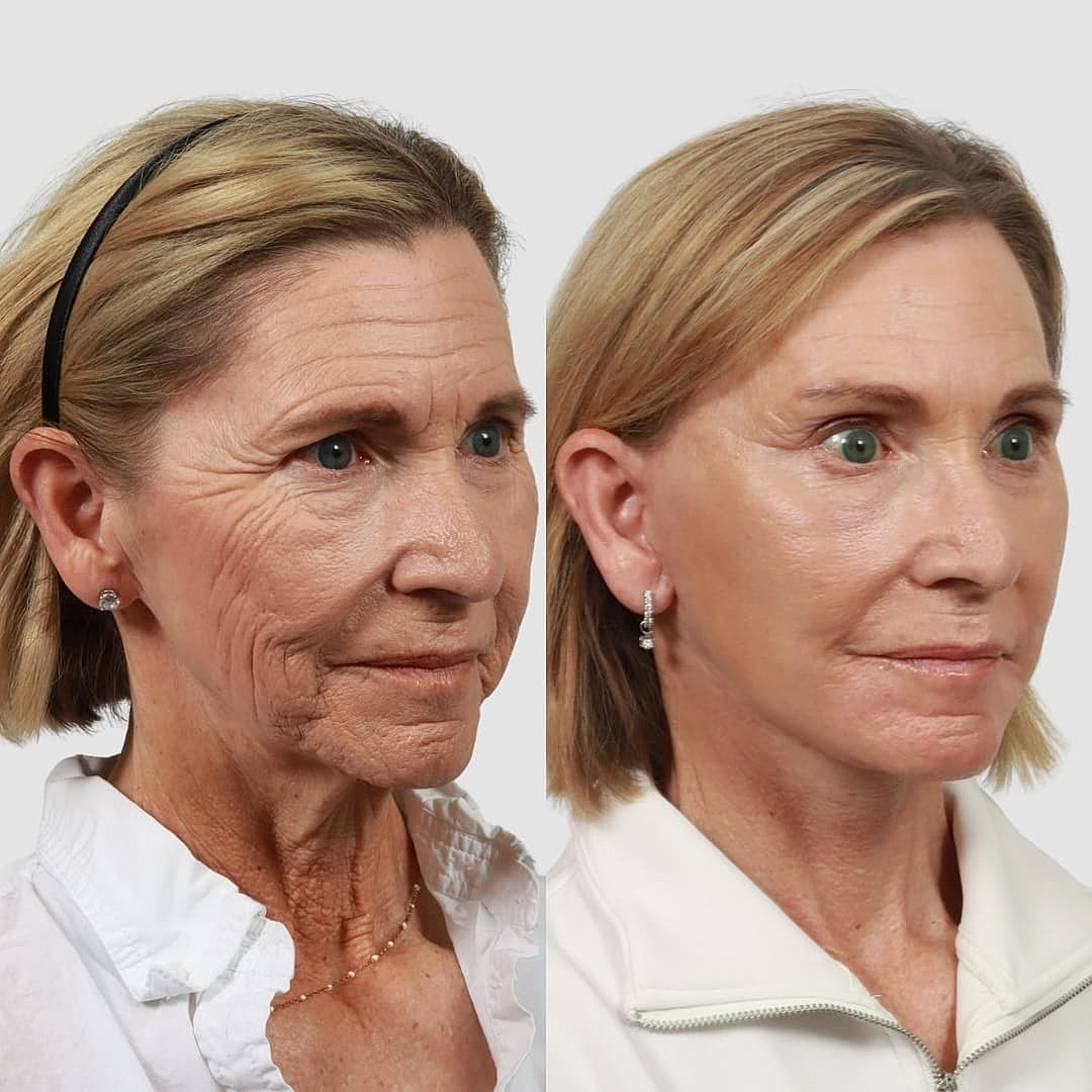 Deep Plane Facelift Before & After