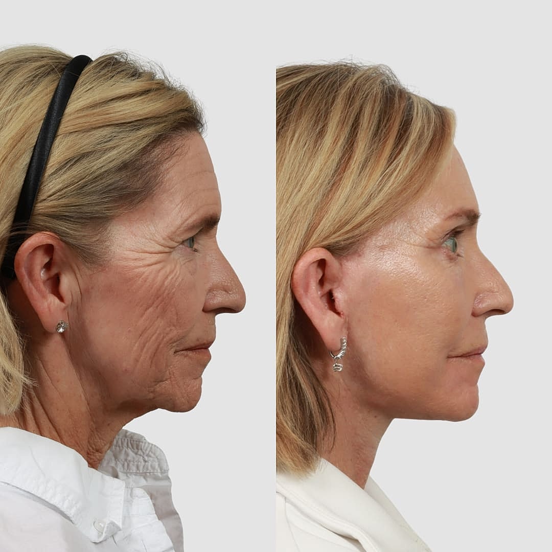 Deep Plane Facelift Before & After