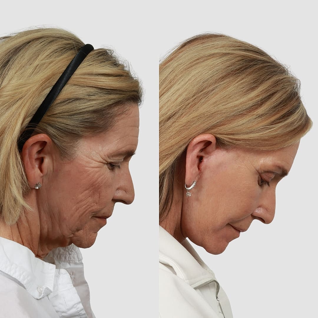 Deep Plane Facelift Before & After