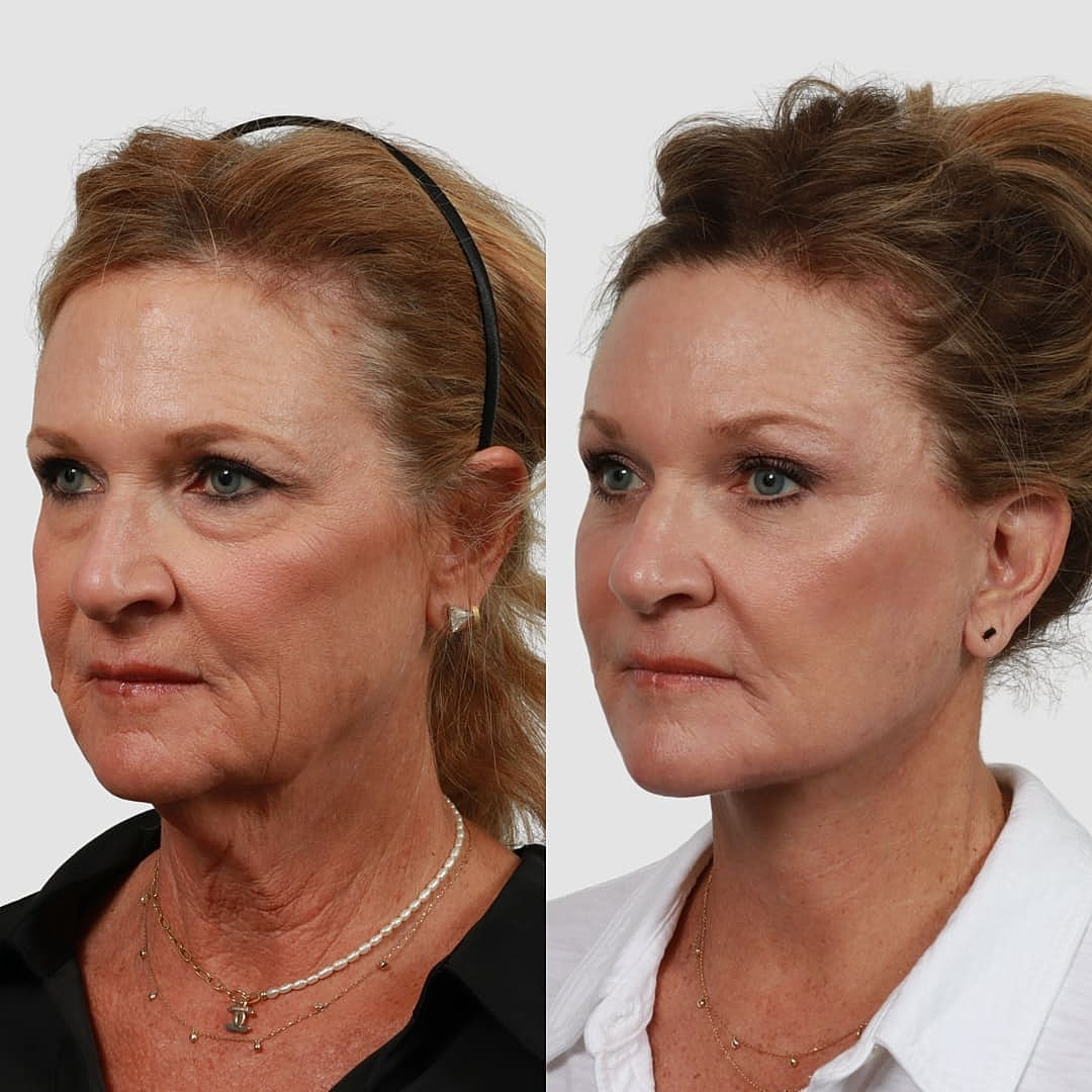 Deep Plane Facelift Before & After
