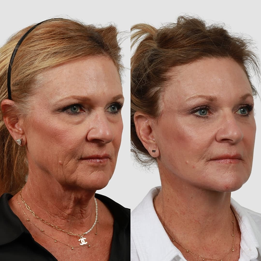 Deep Plane Facelift Before & After