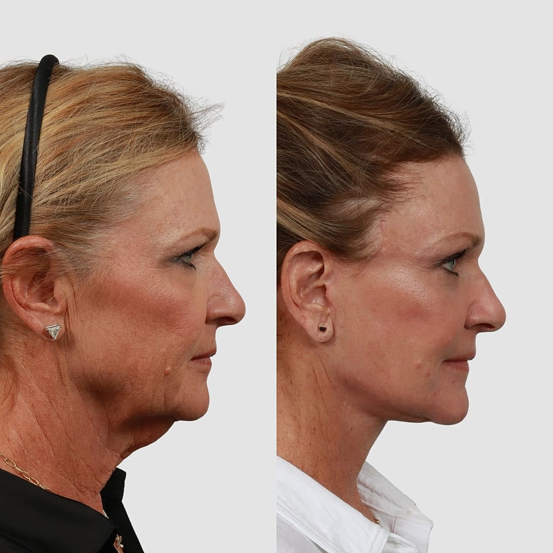 Deep Plane Facelift Before & After