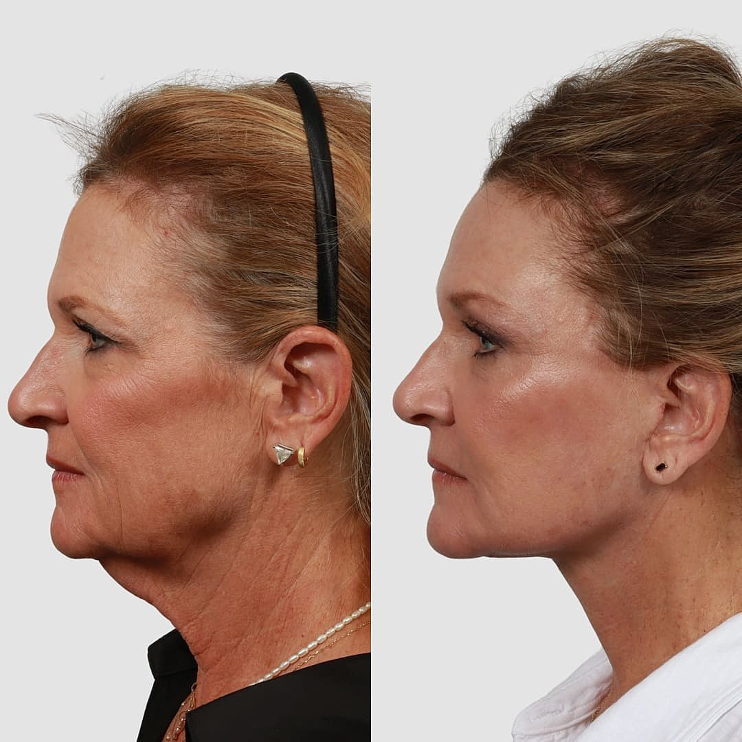 Deep Plane Facelift Before & After