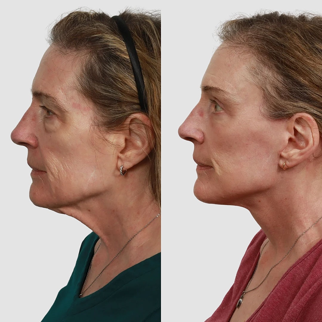 Deep Plane Facelift Before & After