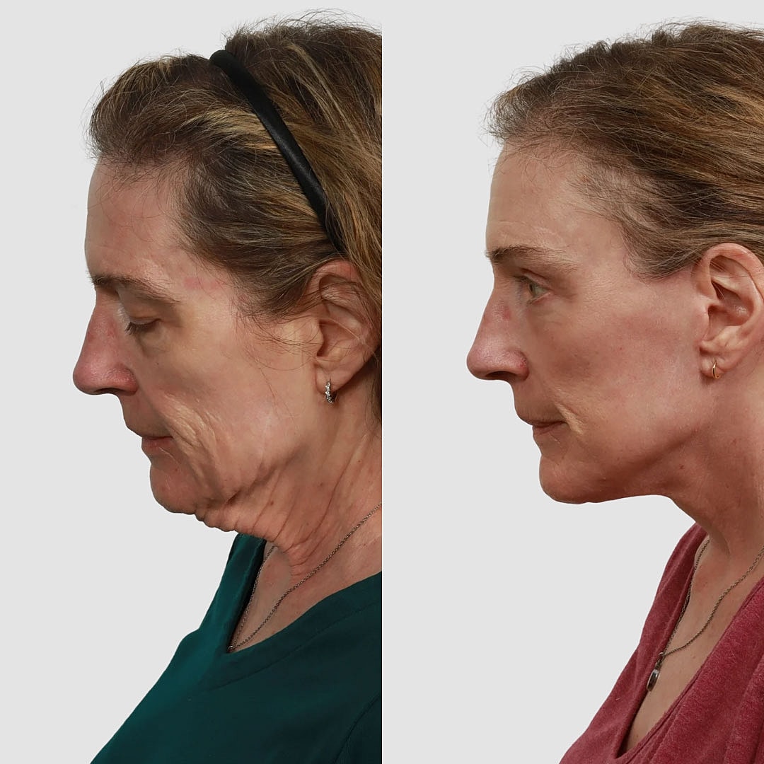 Deep Plane Facelift Before & After