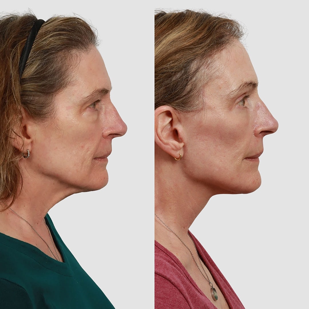 Deep Plane Facelift Before & After