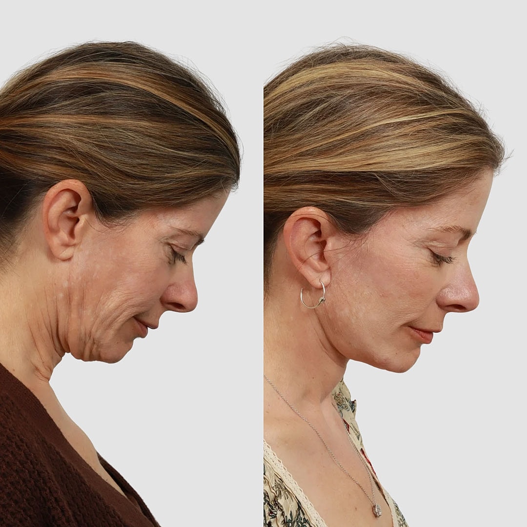 Deep Plane Facelift Before & After