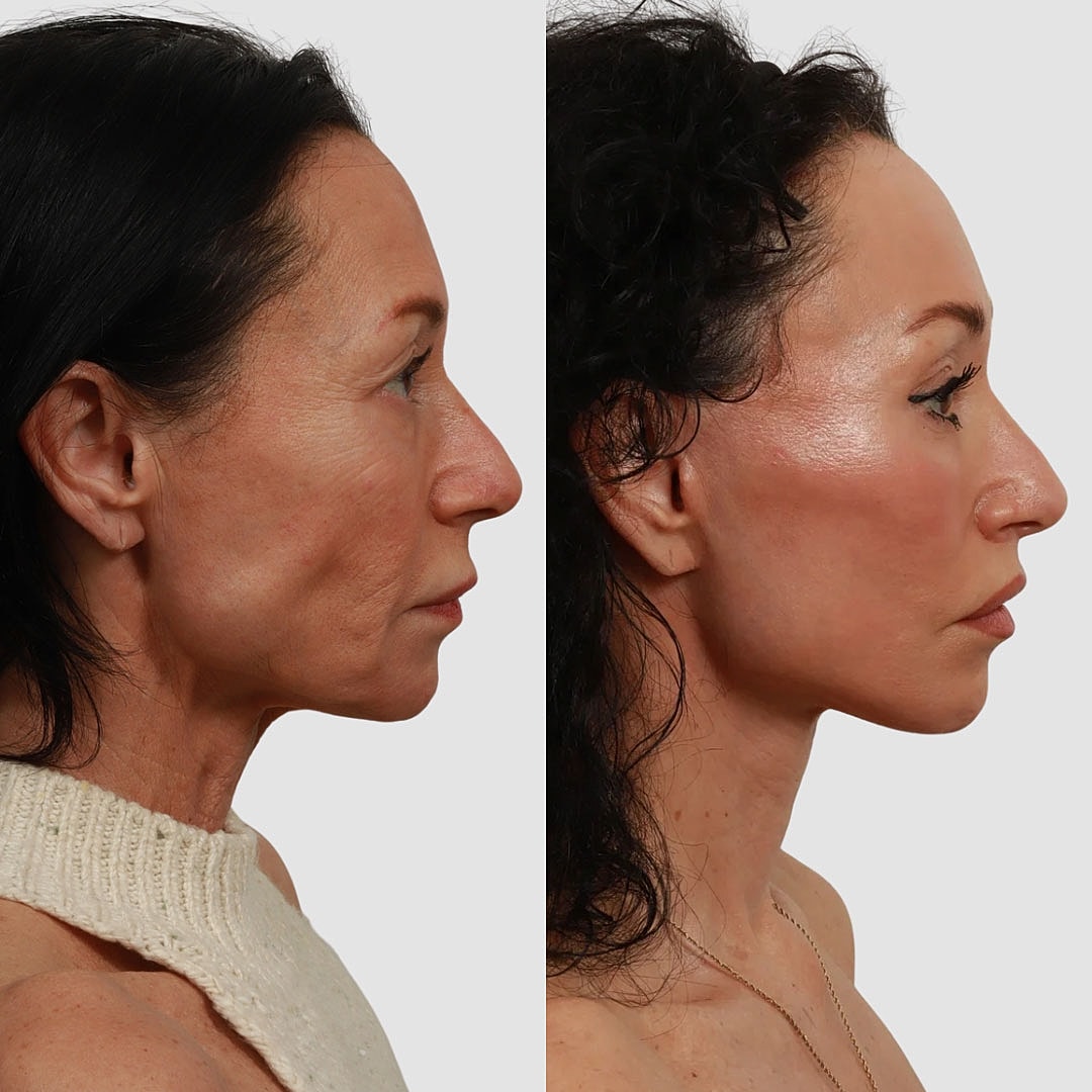 Deep Plane Facelift Before & After