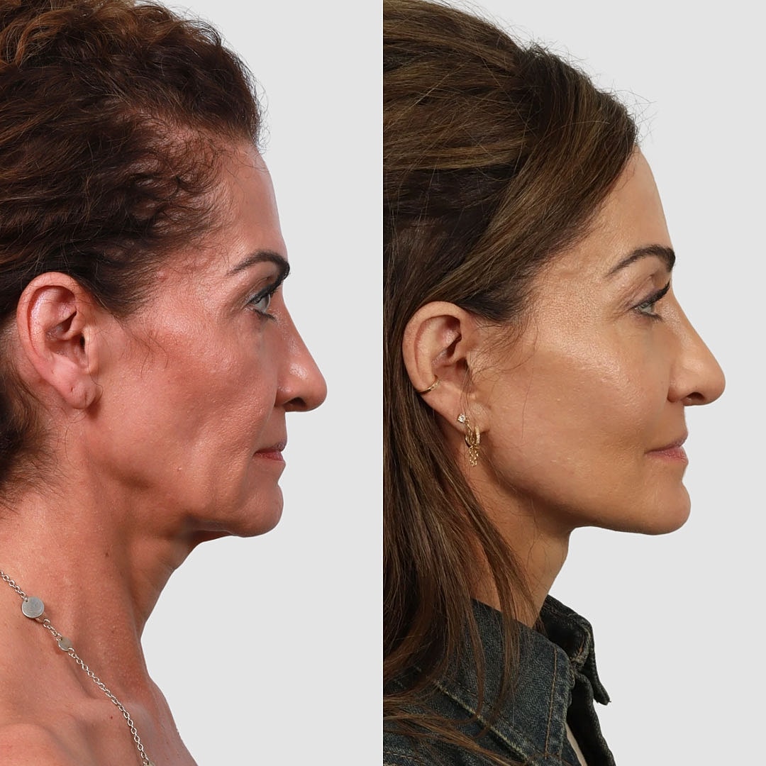 Deep Plane Facelift Before & After