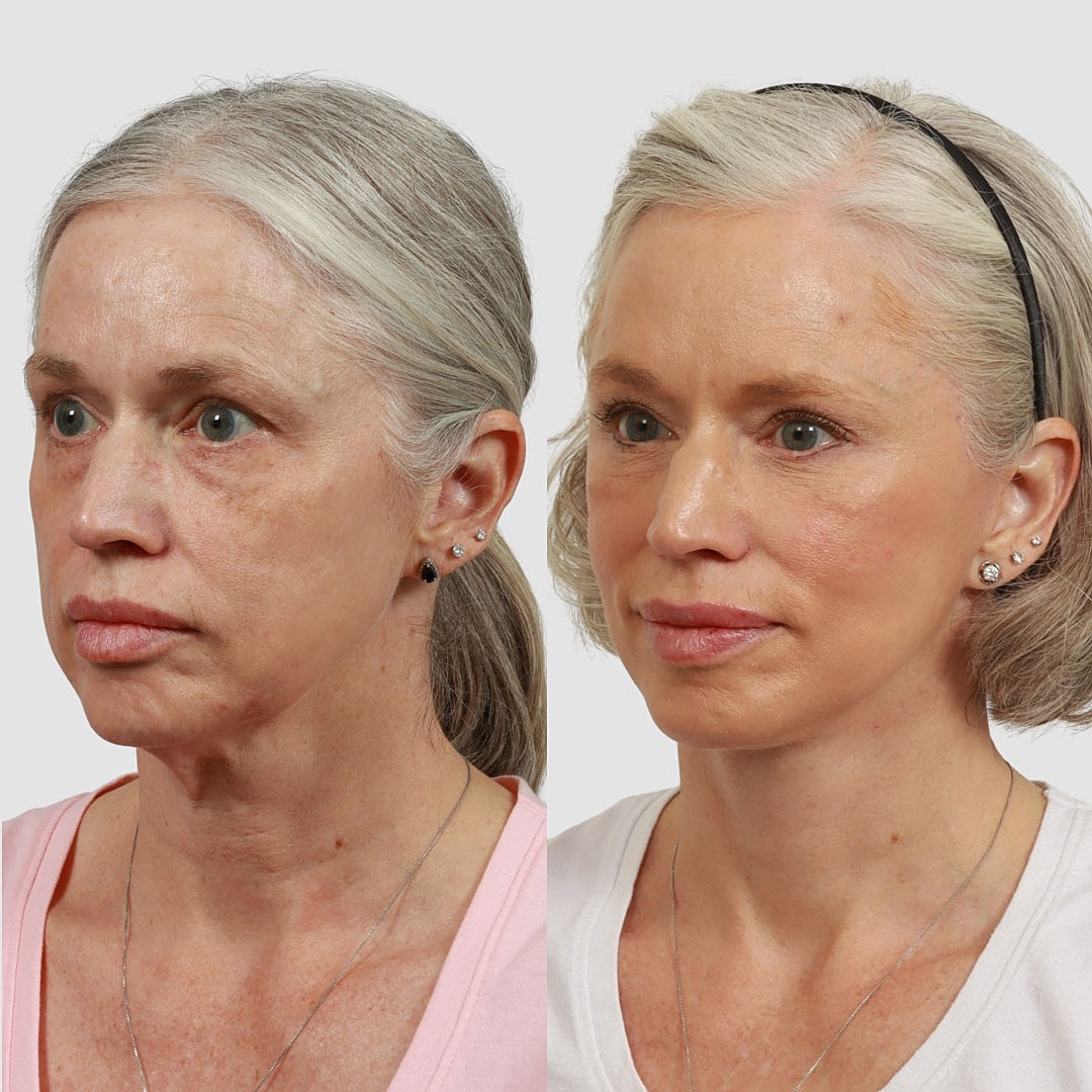Deep Plane Facelift Before & After