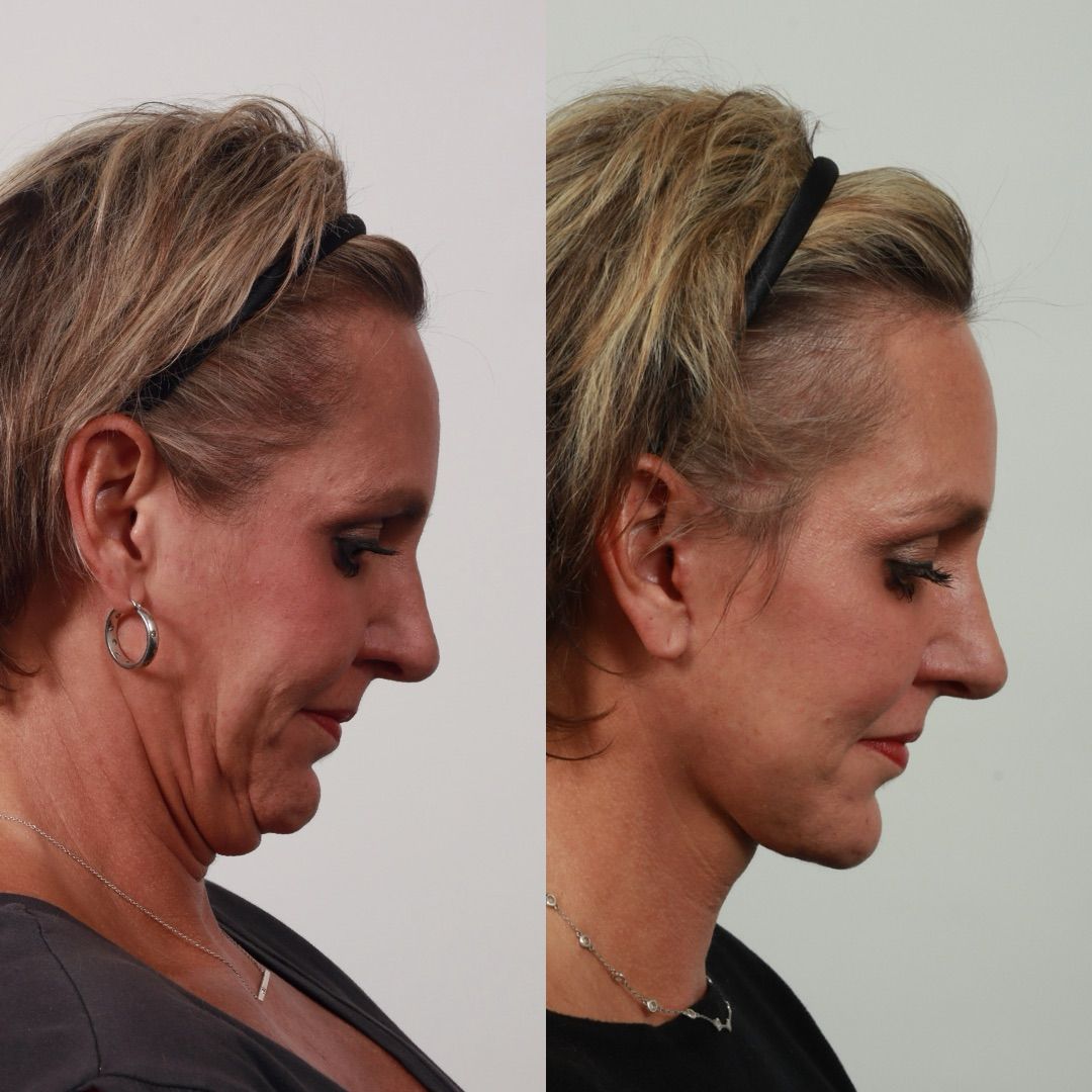 Deep Plane Facelift Before & After