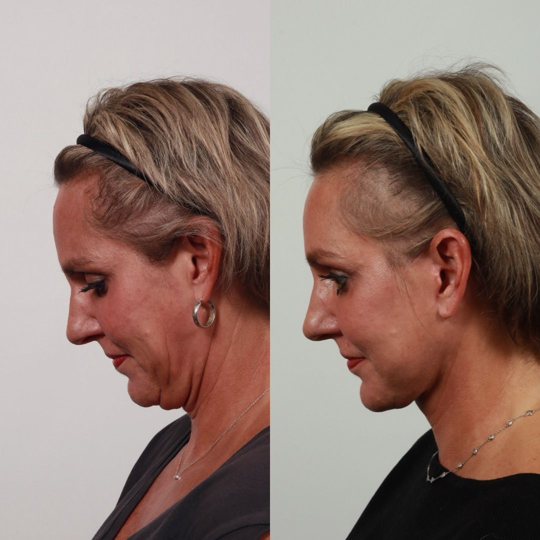 Deep Plane Facelift Before & After