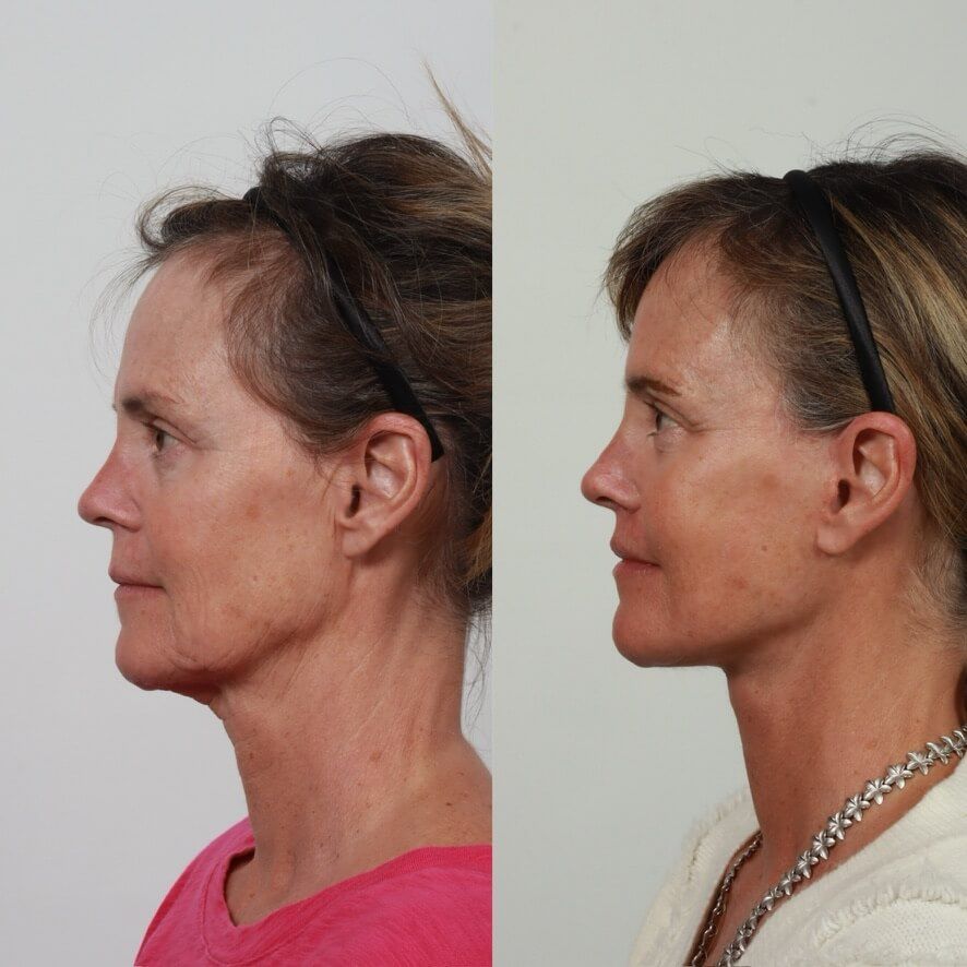Deep Plane Facelift Before & After