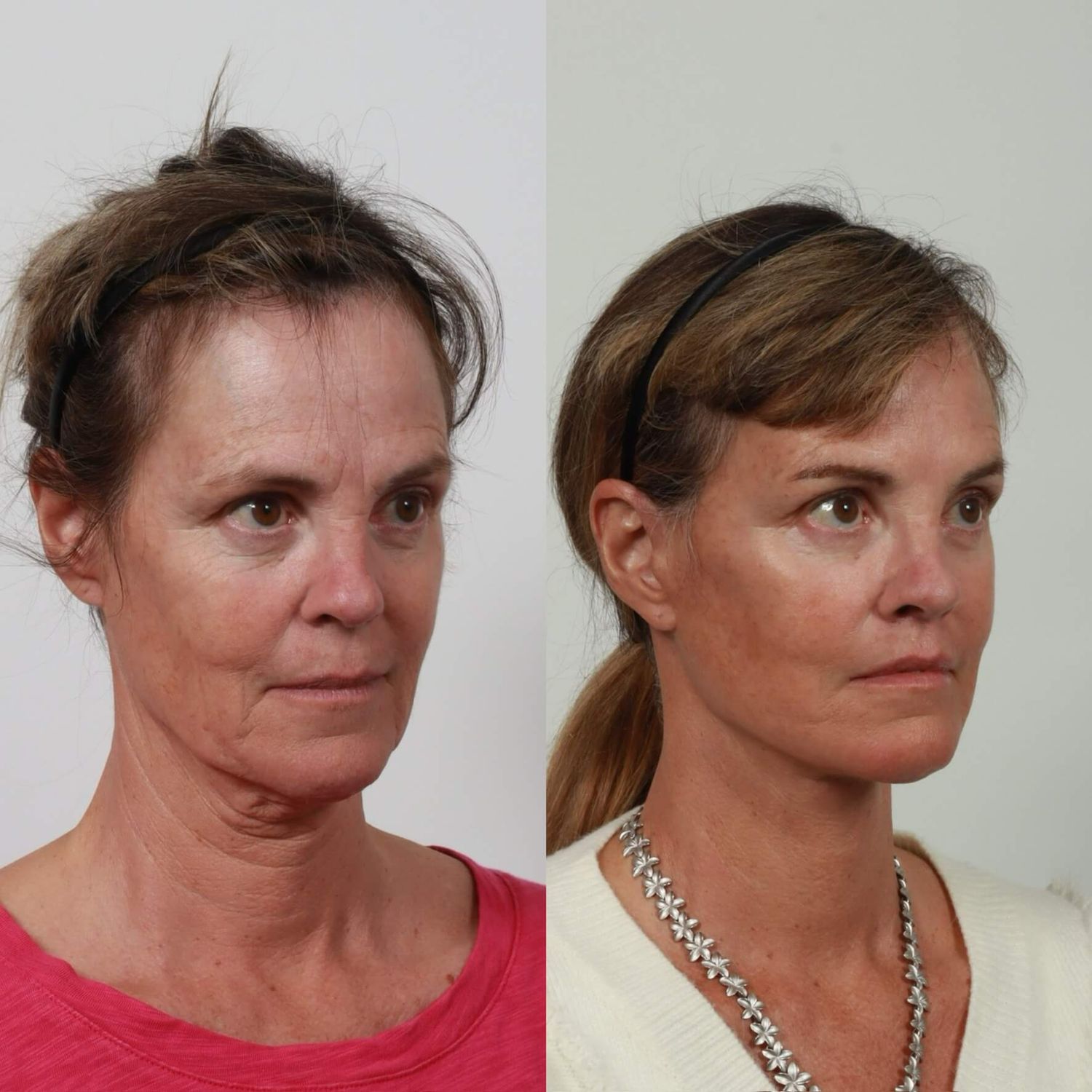 Deep Plane Facelift Before & After