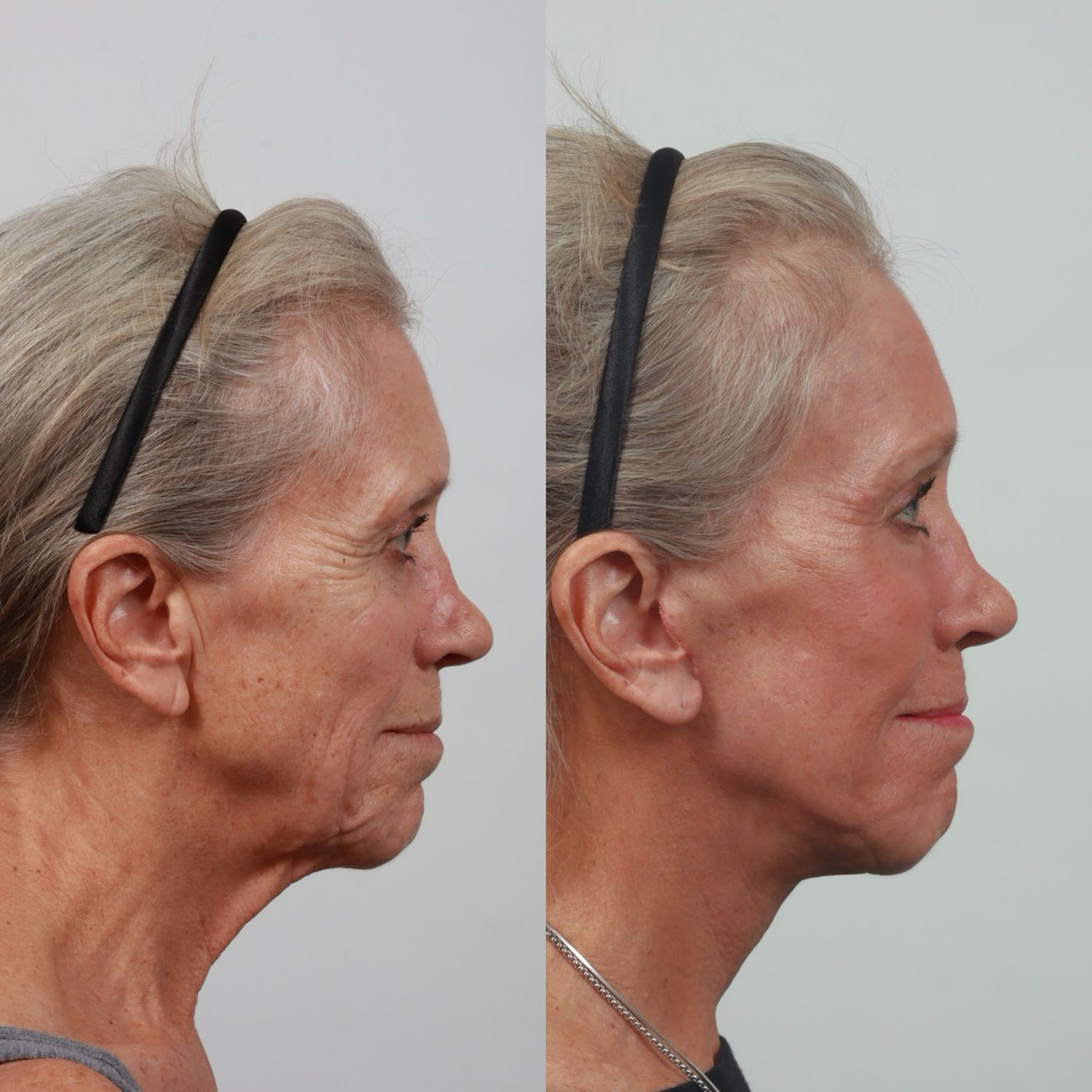 Deep Plane Facelift Before & After
