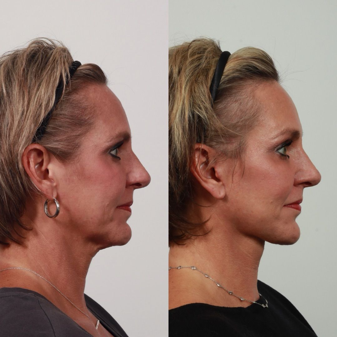 Deep Plane Facelift Before & After