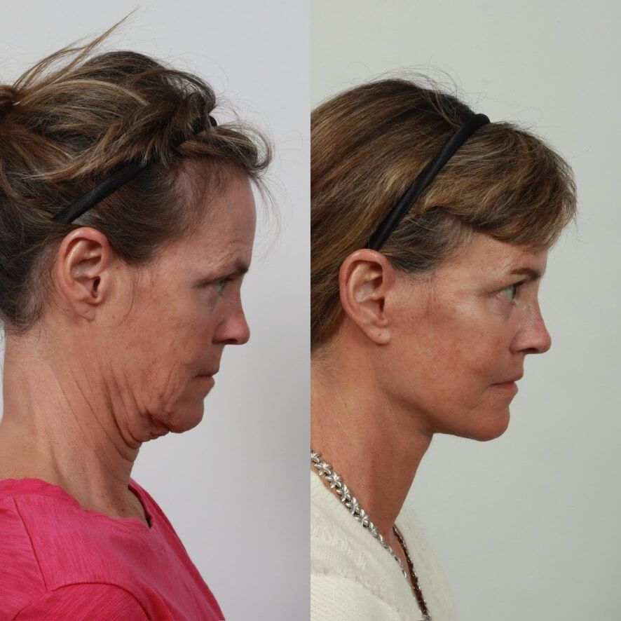 Deep Plane Facelift Before & After