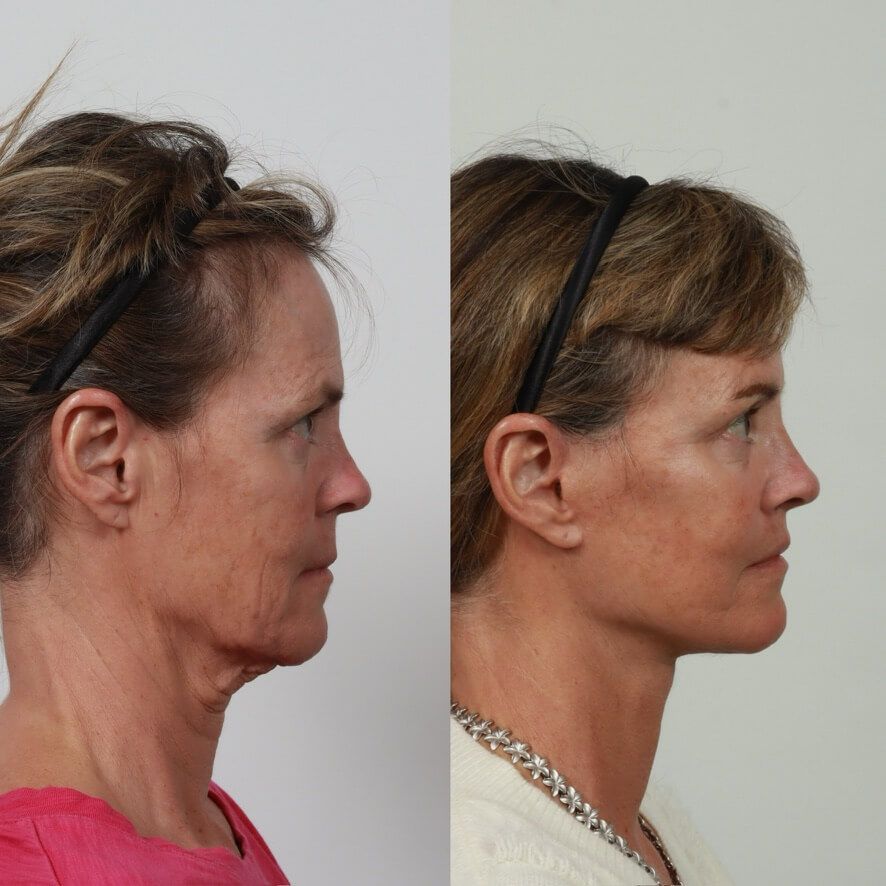 Deep Plane Facelift Before & After