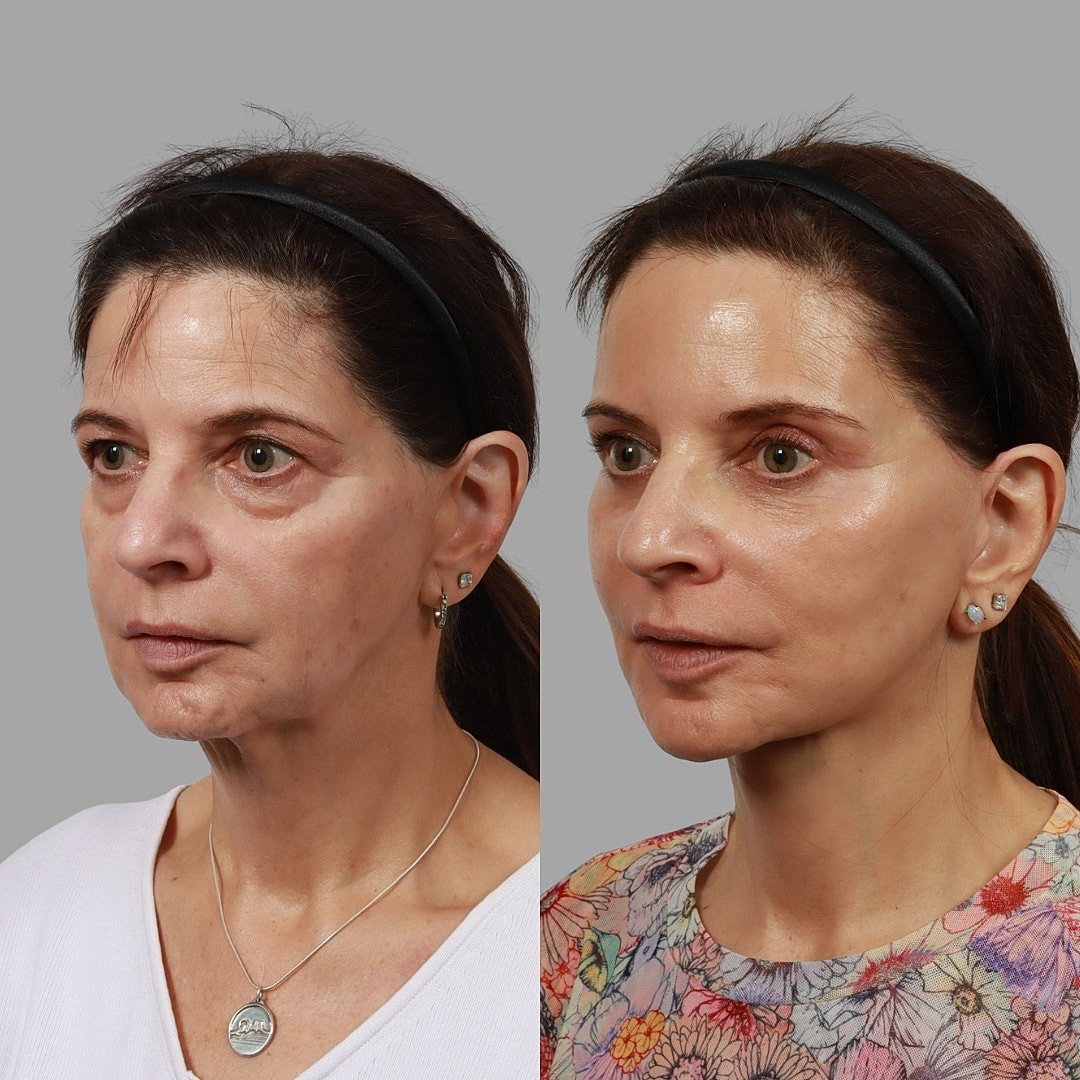 Deep Plane Facelift Before & After