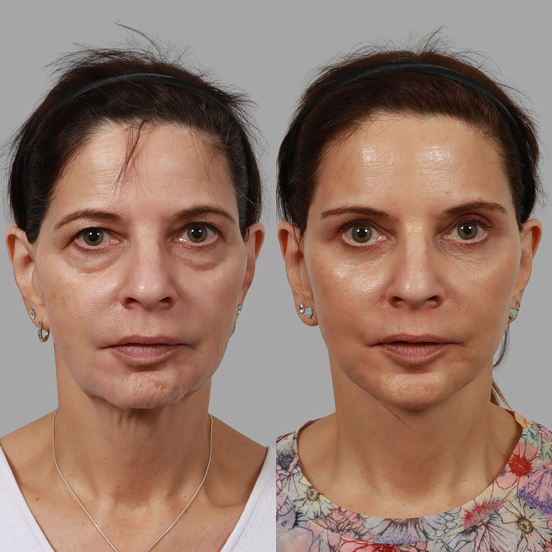 Deep Plane Facelift Before & After