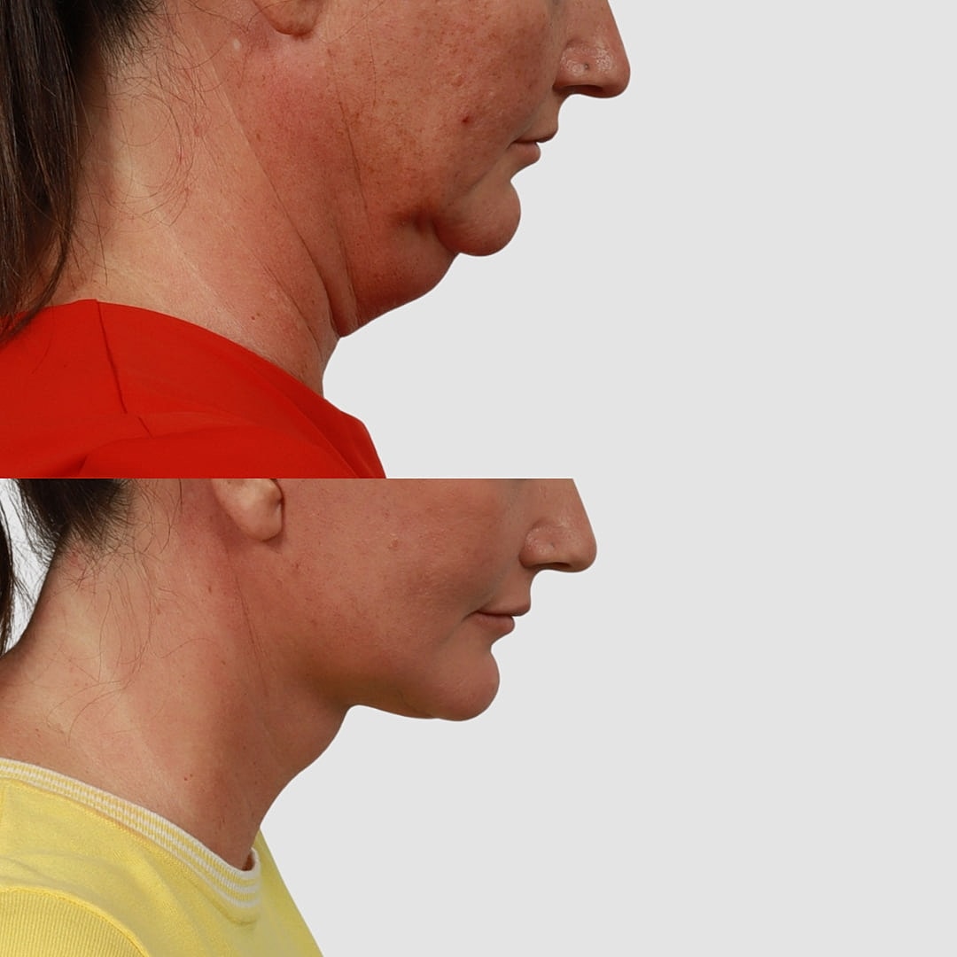 Deep Plane Neck Lift Before & After