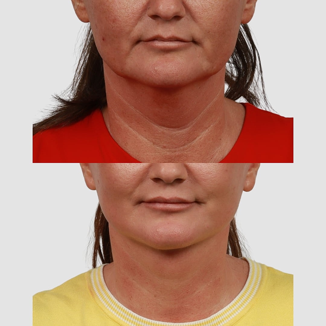 Deep Plane Neck Lift Before & After