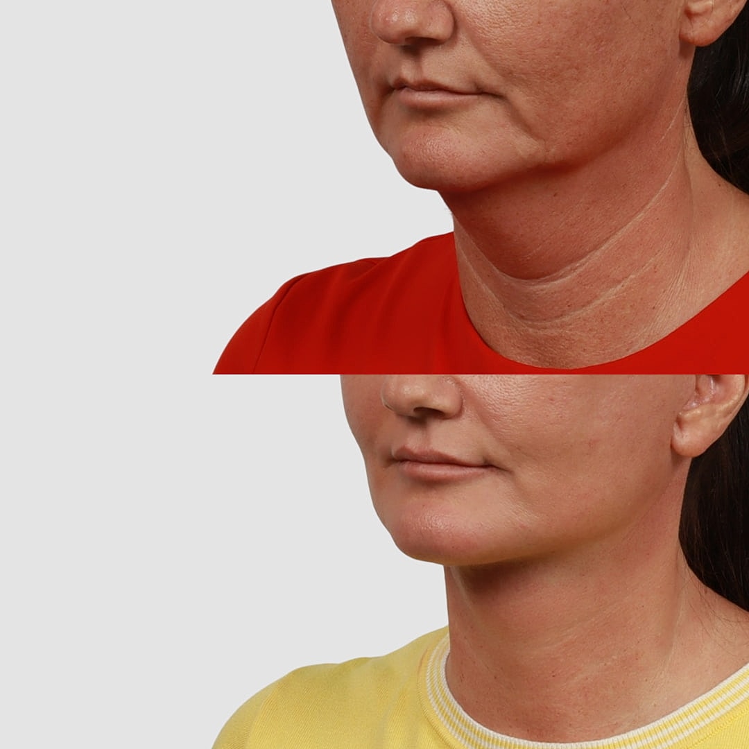 Deep Plane Neck Lift Before & After