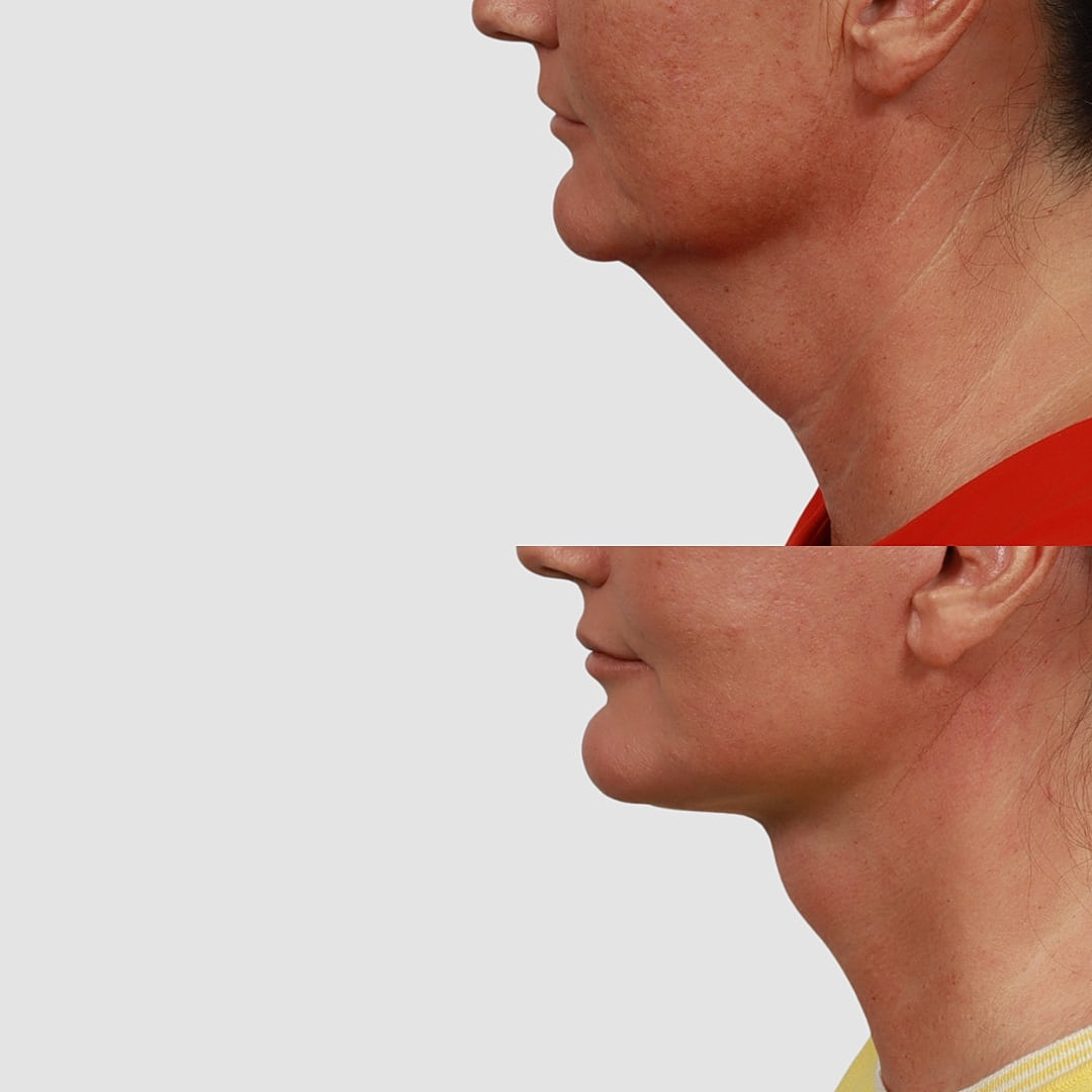 Deep Plane Neck Lift Before & After