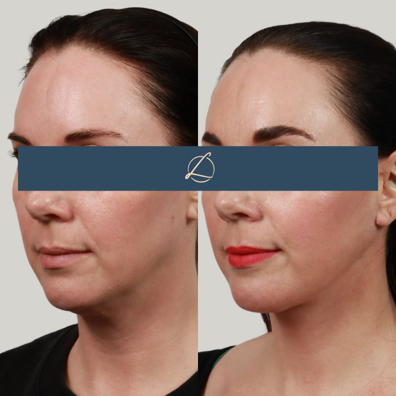 Deep Plane Neck Lift Before & After