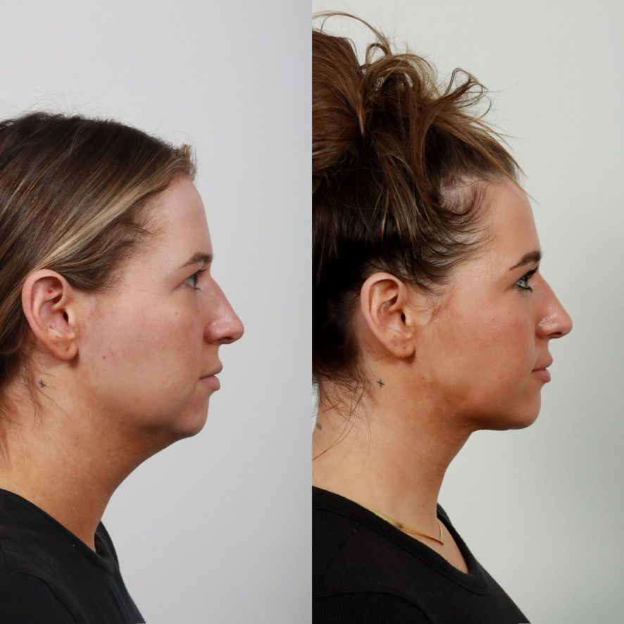 Deep Plane Neck Lift Before & After
