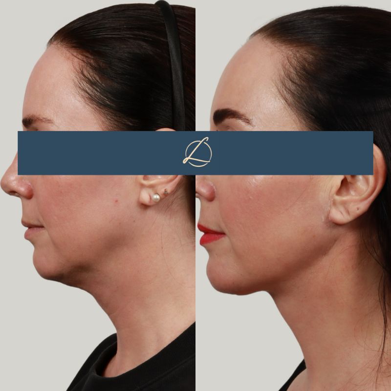 Deep Plane Neck Lift Before & After