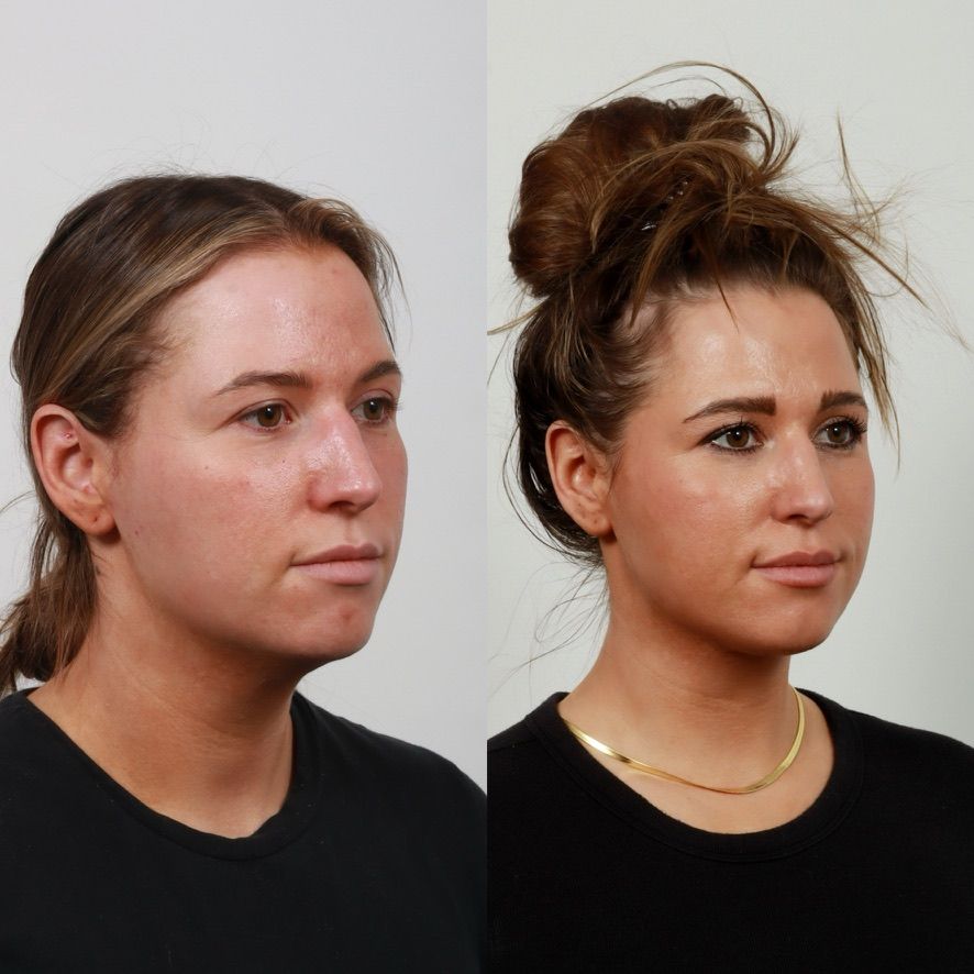 Deep Plane Neck Lift Before & After