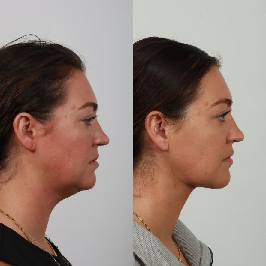 Deep Plane Neck Lift Before & After