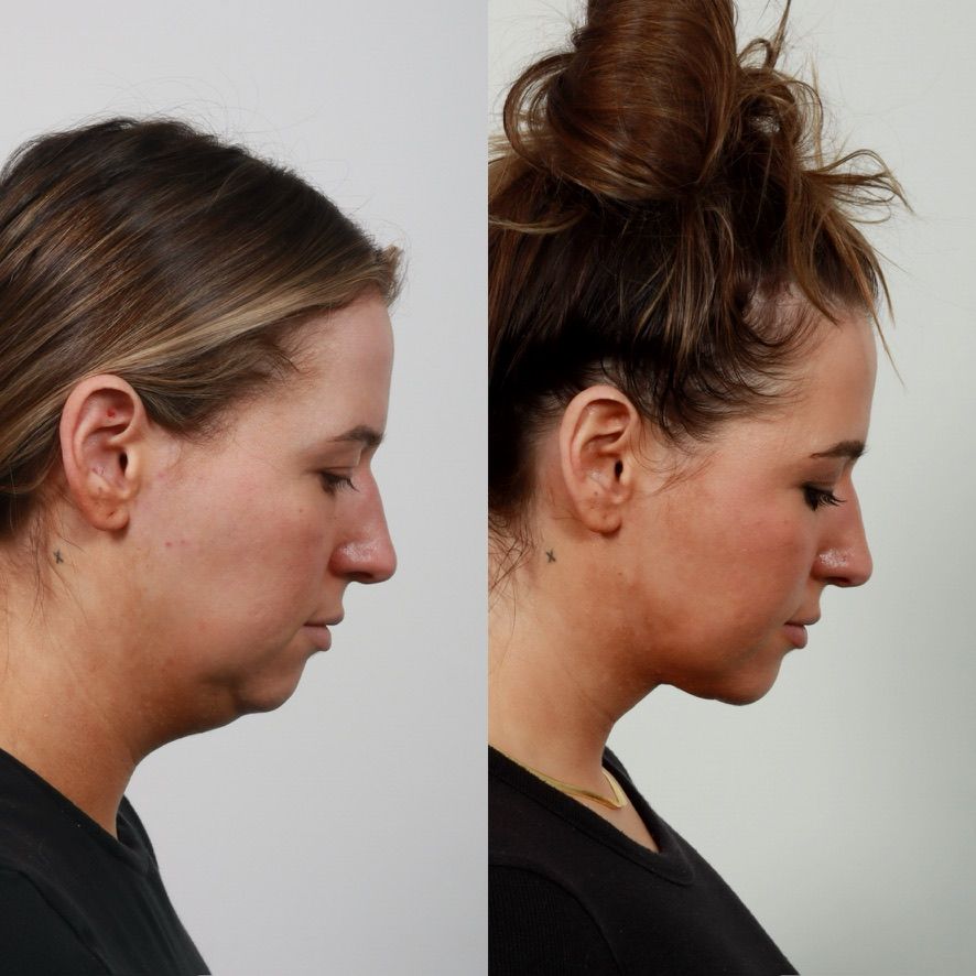 Deep Plane Neck Lift Before & After